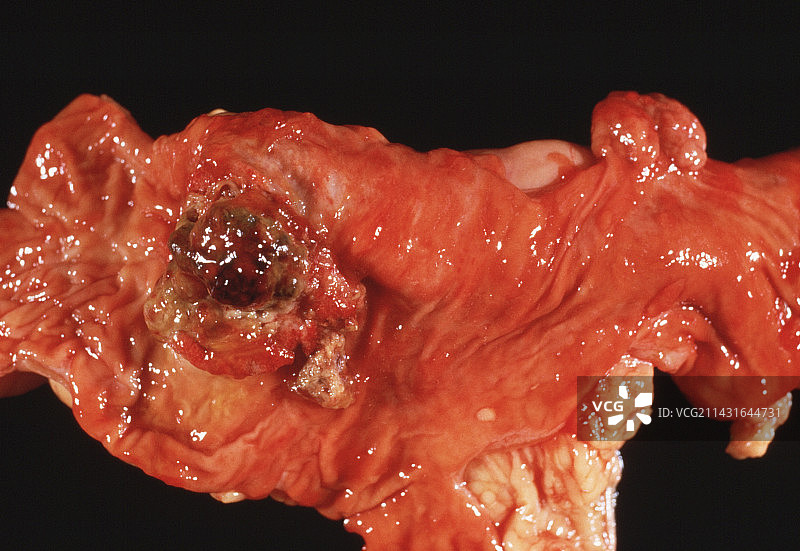 结肠癌图片素材