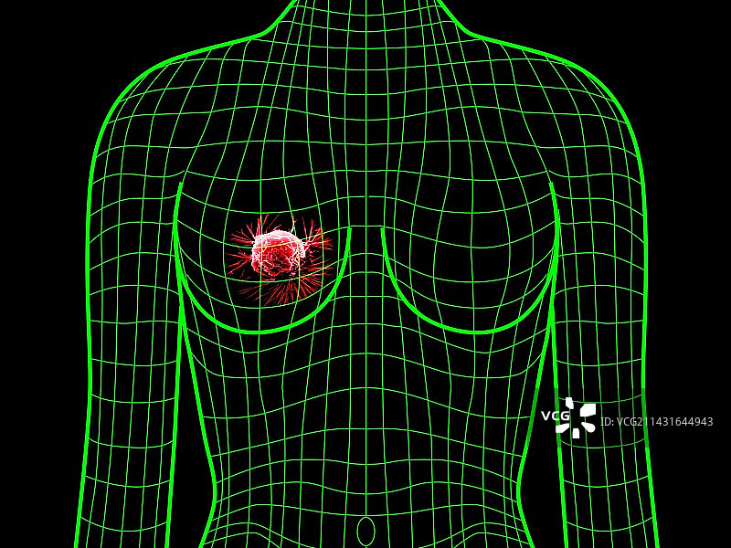 乳腺癌图片素材