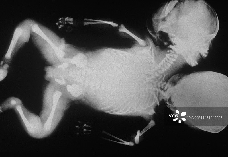 双头婴儿X光片图片素材