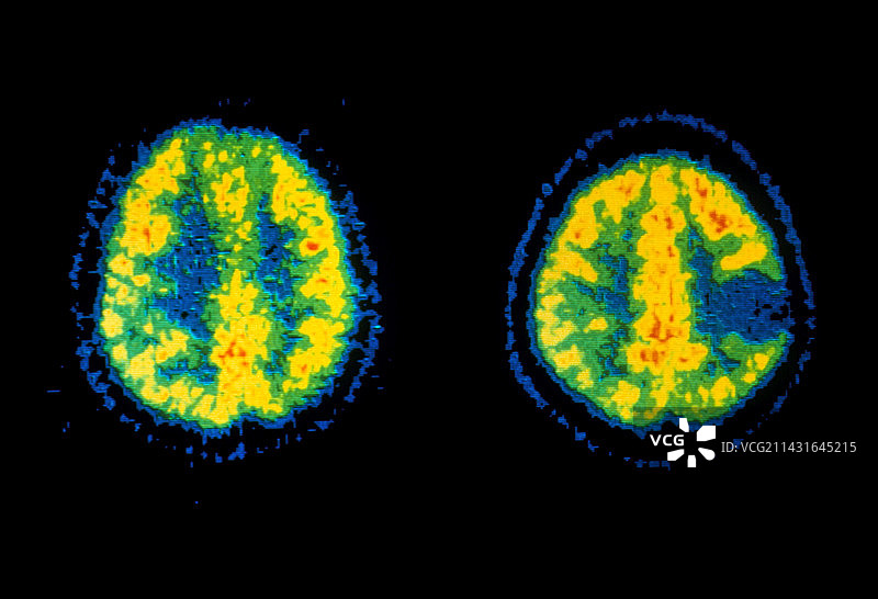健康大脑与癌变大脑图片素材