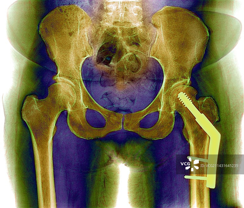 股骨骨折图片素材