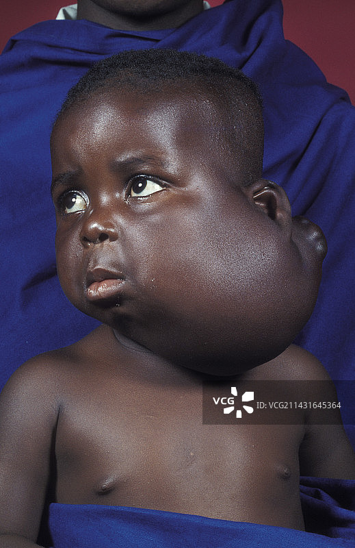 良性囊性生长图片素材