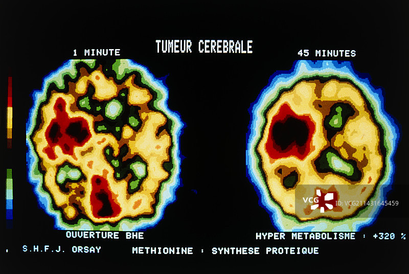 脑肿瘤轴位PET扫描图片素材