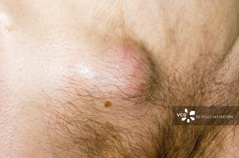 绞窄疝图片素材