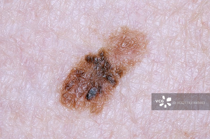 黑色素瘤皮肤癌扩散图片素材