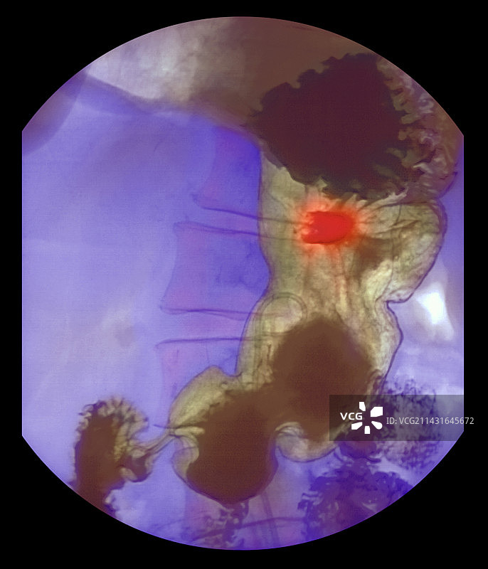 胃溃疡X光片图片素材