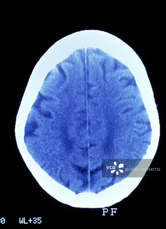 痴呆症的CT脑部扫描图片素材