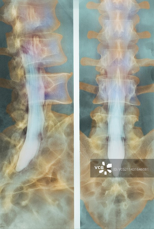 正常的脊髓X光片图片素材