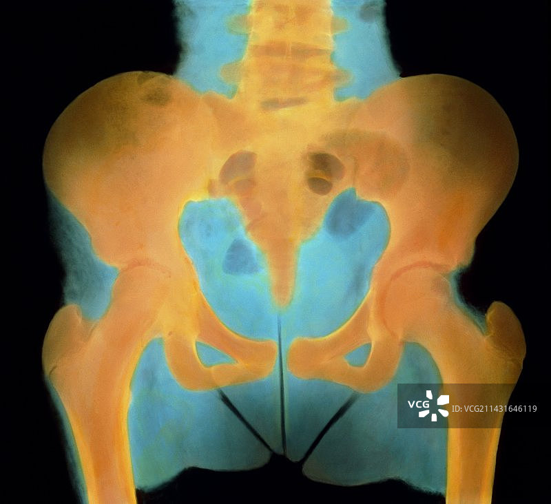 13岁女孩的彩色骨盆X光片图片素材