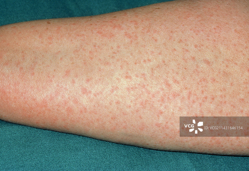 前臂上的青霉素过敏反应图片素材