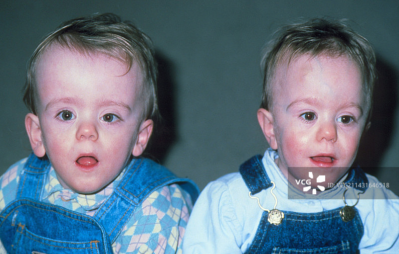 患有脑积水的双胞胎男孩（18个月大）图片素材