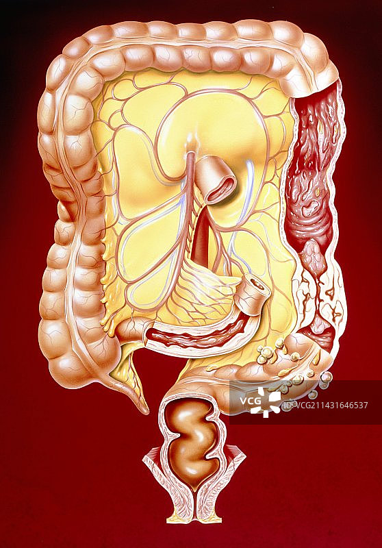 克罗恩病、结肠炎、结肠癌艺术作品图片素材