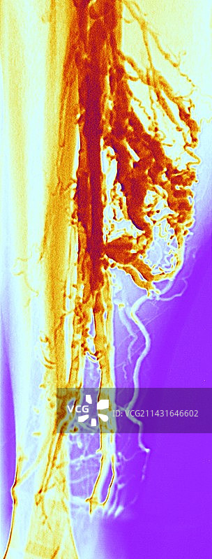 静脉曲张X光片图片素材