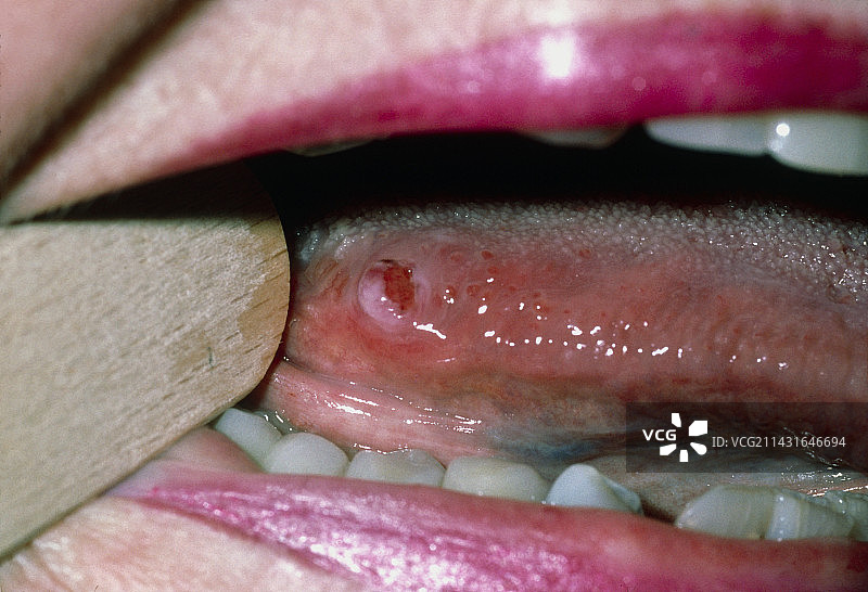 女性舌头上的恶性平滑肌肉瘤图片素材