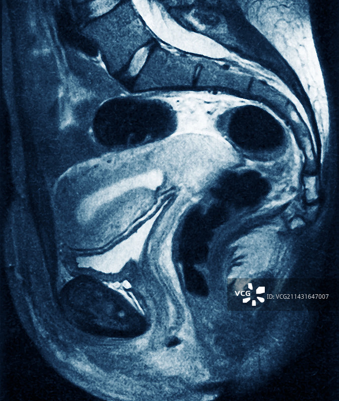 子宫癌MRI扫描图片素材