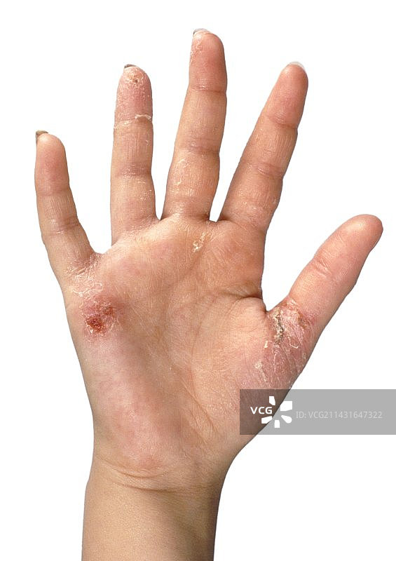 女孩的手部患有接触性皮炎图片素材