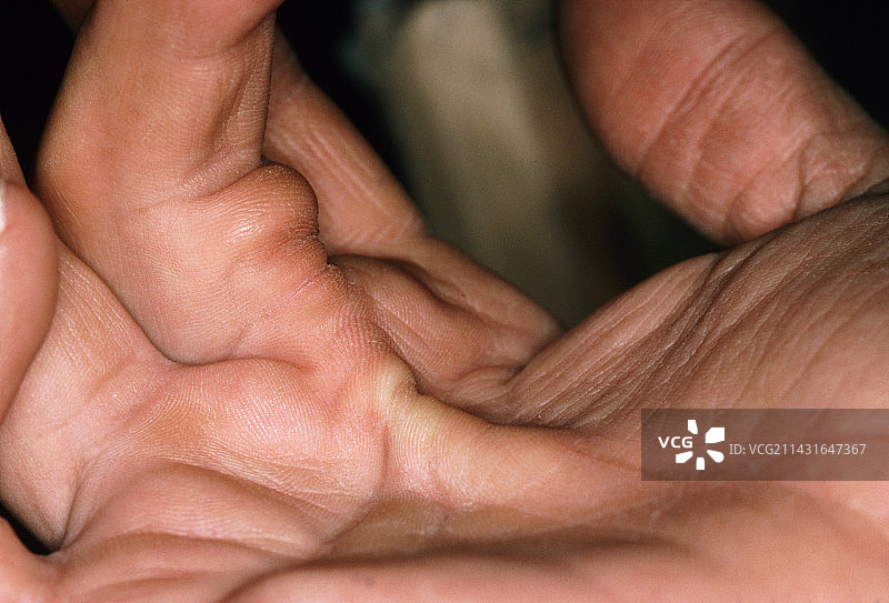 患者右手上的杜普伊特伦挛缩图片素材