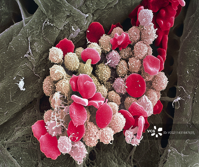 白血病血细胞图片素材