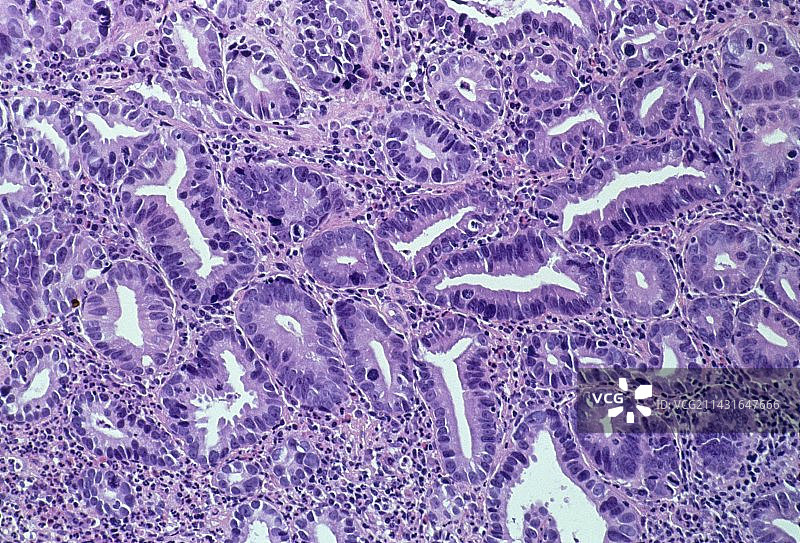 胃腺癌的光学显微照片图片素材