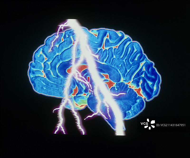 带有闪电的脑部扫描：头痛或癫痫图片素材