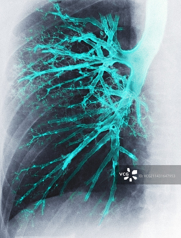 肺部X光片图片素材