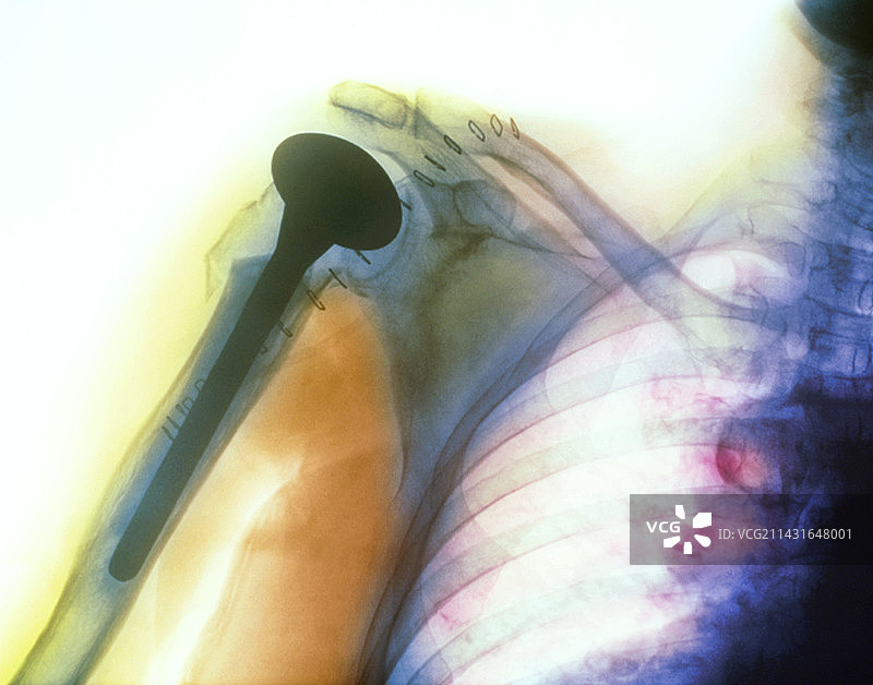 肩关节假体X光片图片素材