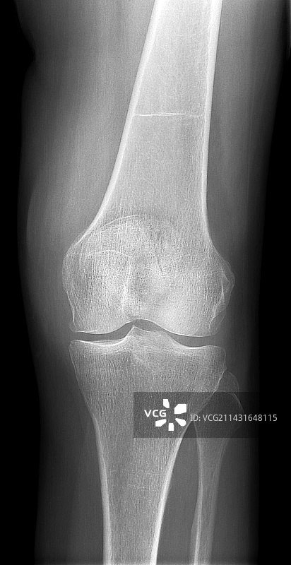 关节炎膝盖X光片图片素材