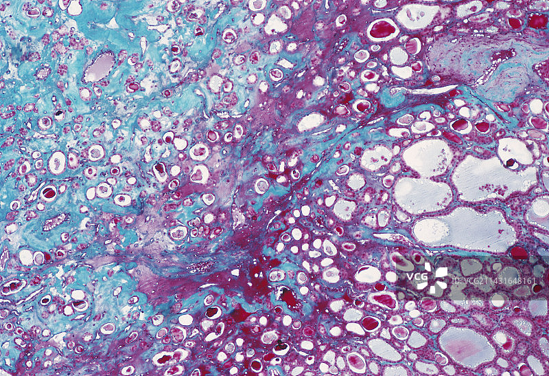 甲状腺腺瘤图片素材