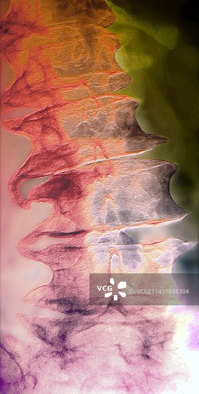 患病脊柱X光片图片素材