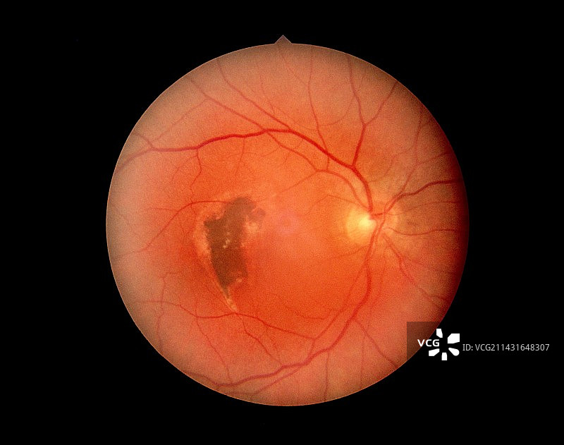 视网膜病变，显示视网膜脱离图片素材