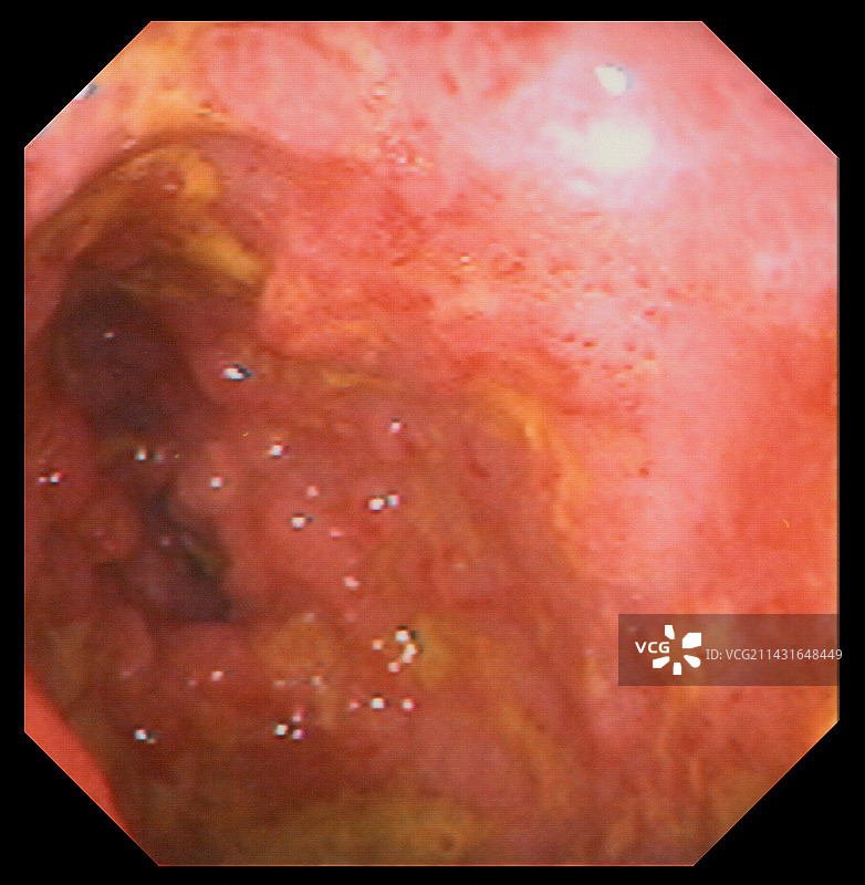 克罗恩病图片素材