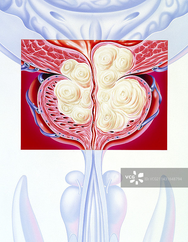 良性前列腺增生插画图片素材