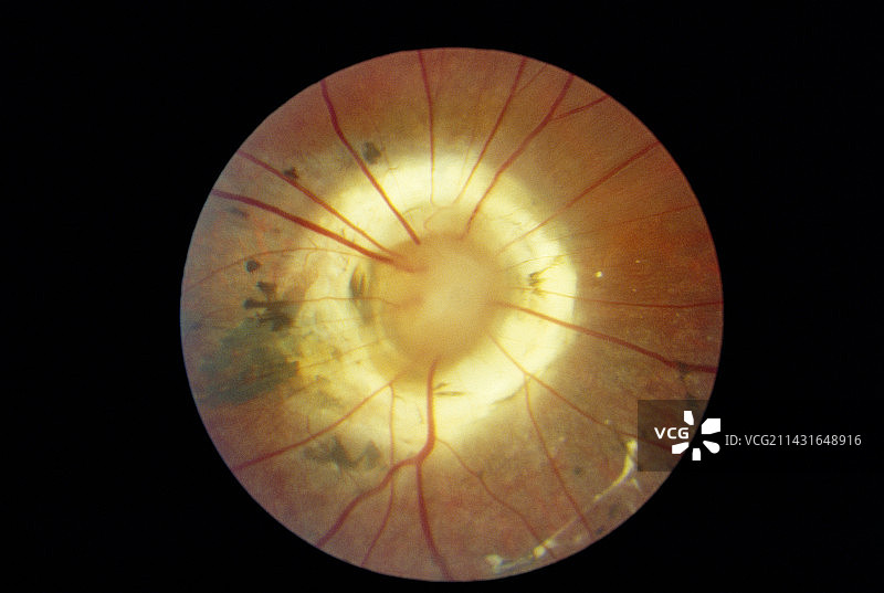 青光眼图片素材