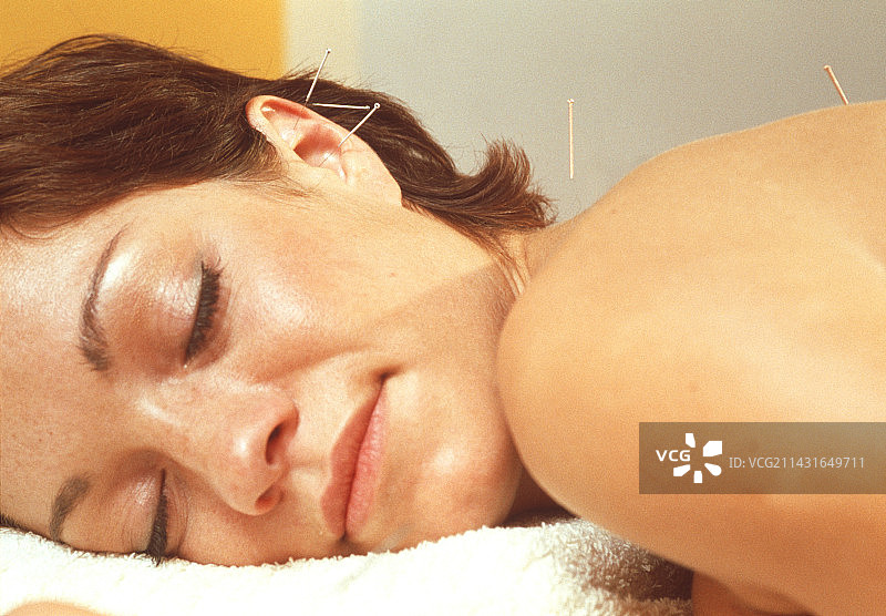 针灸图片素材