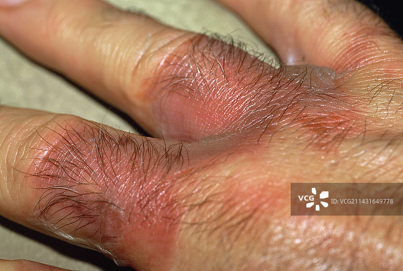 烧伤治疗图片素材