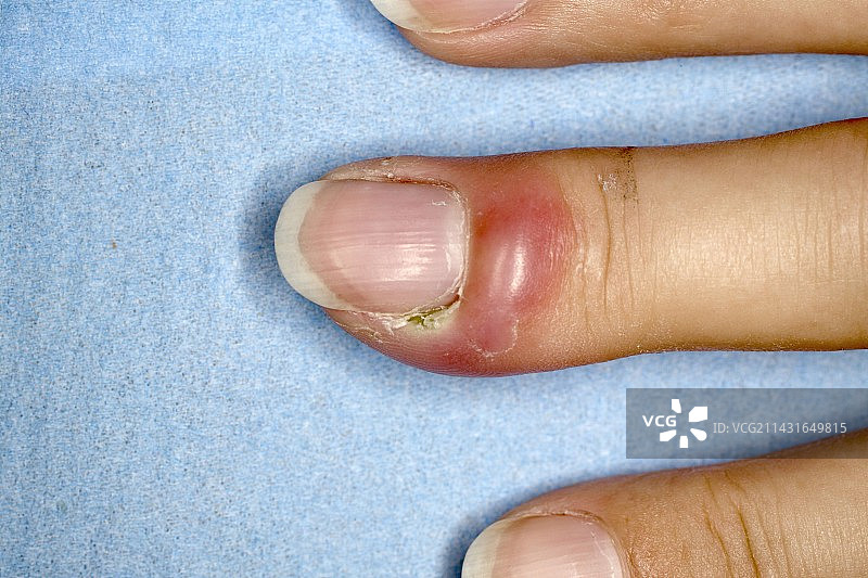 甲沟炎感染图片素材