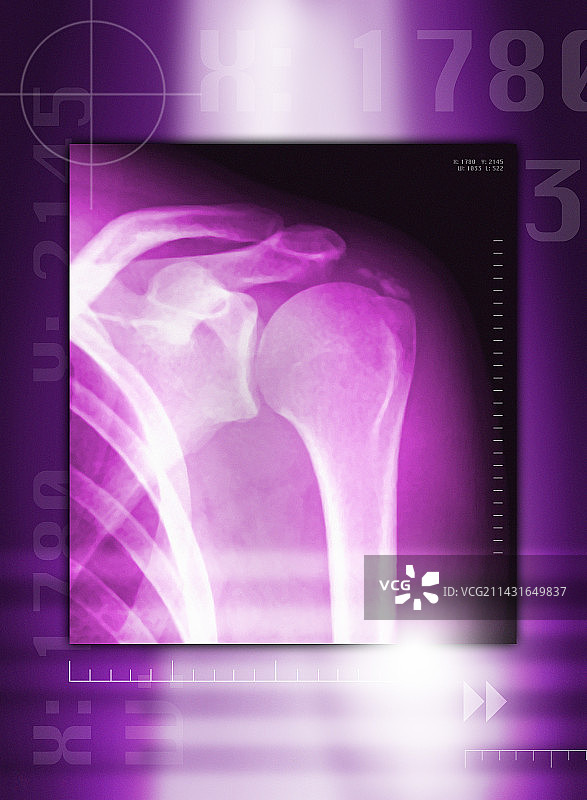 肩关节钙化X光片图片素材