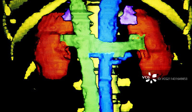 彩色3D CT扫描显示健康肾脏图片素材