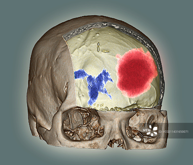 脑出血CT扫描图片素材
