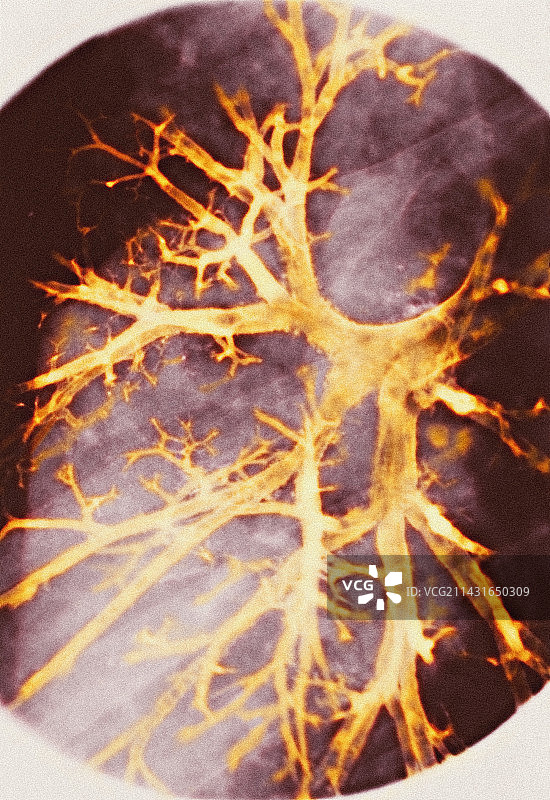 支气管炎，X光片图片素材