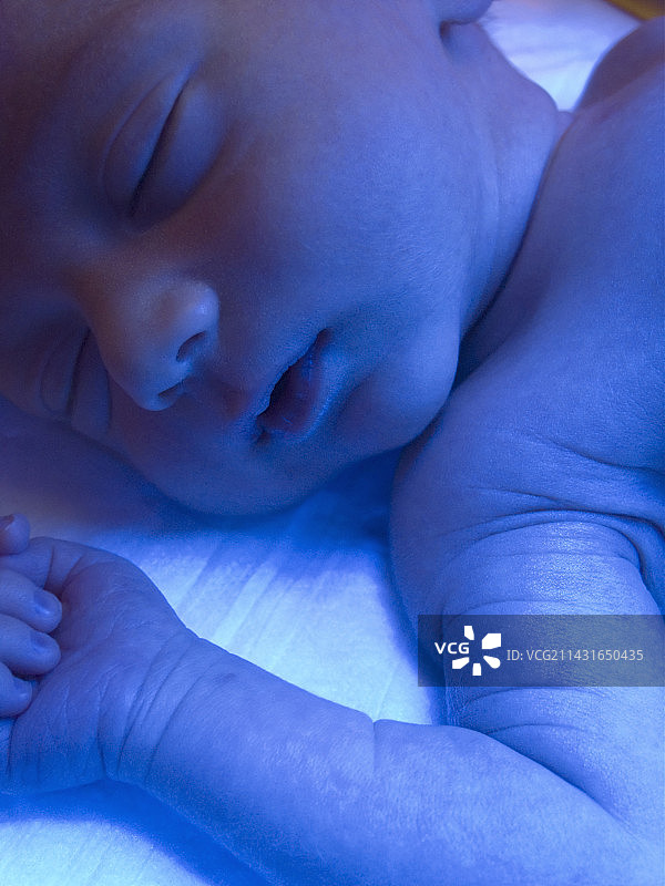 新生儿黄疸光照疗法图片素材