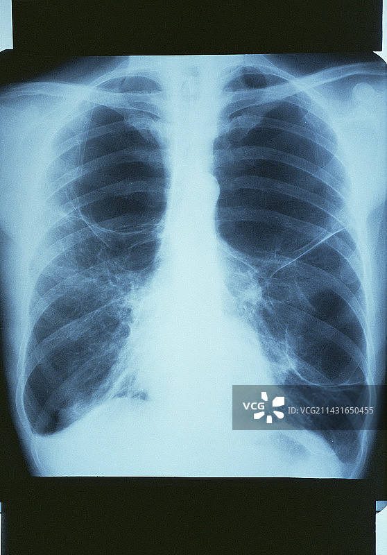 肺气肿X光片图片素材