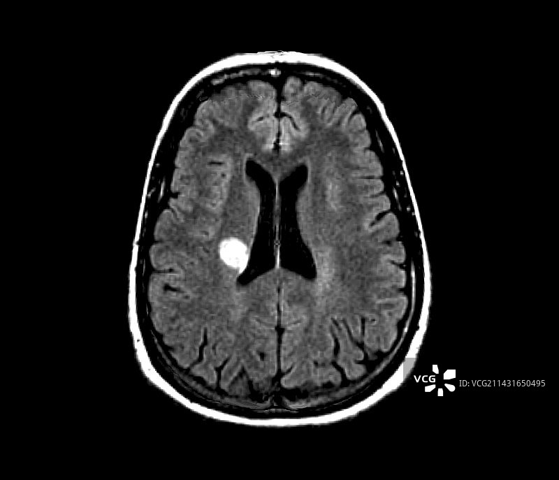 多发性硬化症MRI扫描图片素材