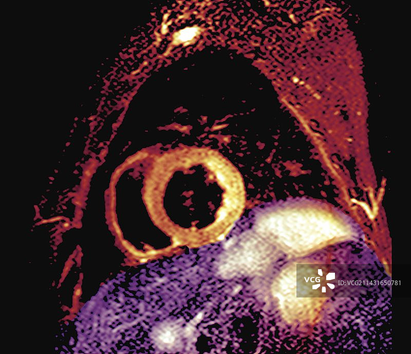 心脏病发作后的心脏图片素材