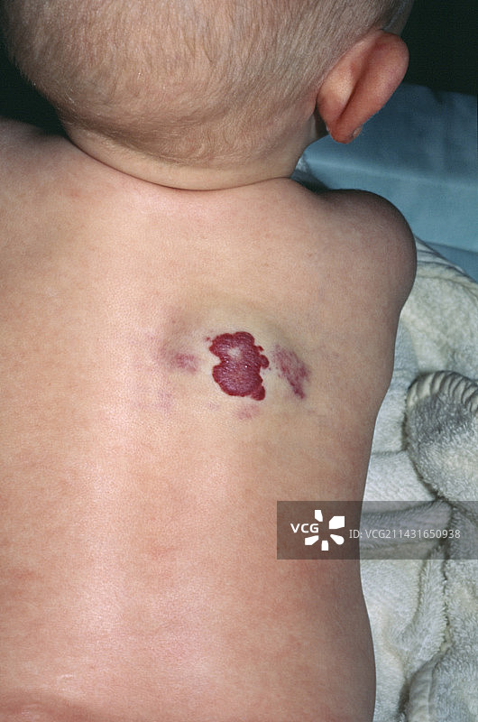 草莓胎记图片素材