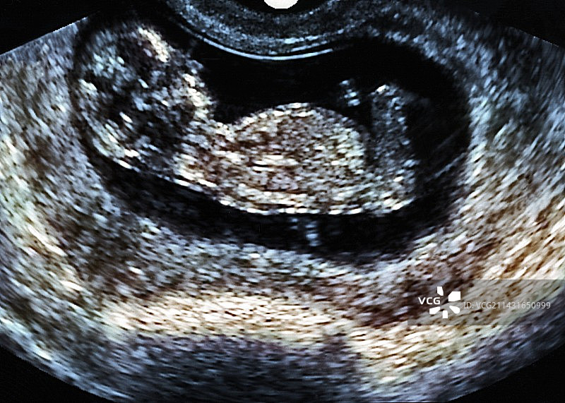 胎儿超声波图片素材