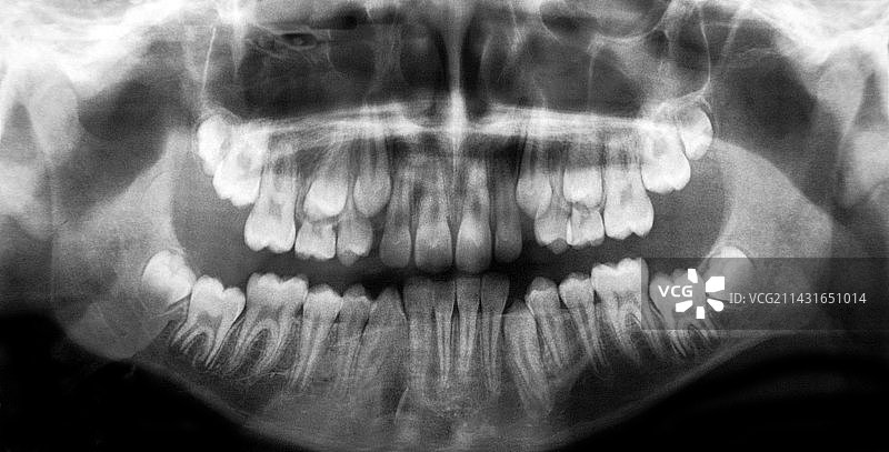 成人牙齿的萌出，X光片图片素材