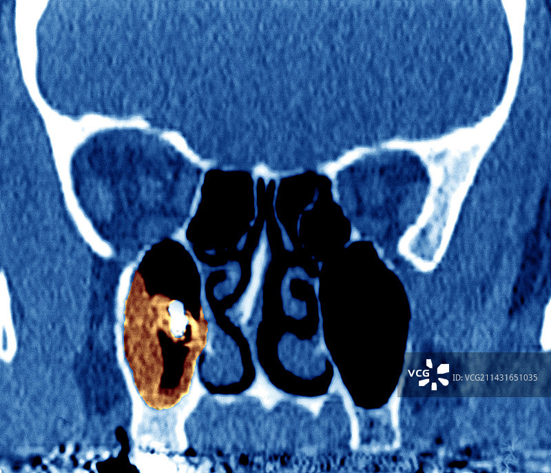 鼻窦炎头部CT扫描图片素材
