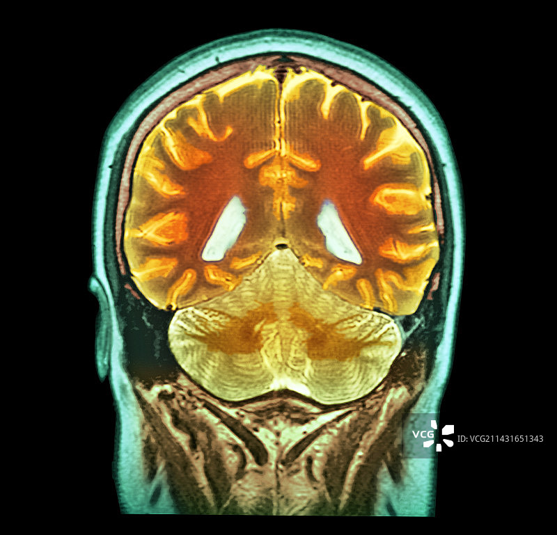 健康的大脑核磁共振扫描图片素材