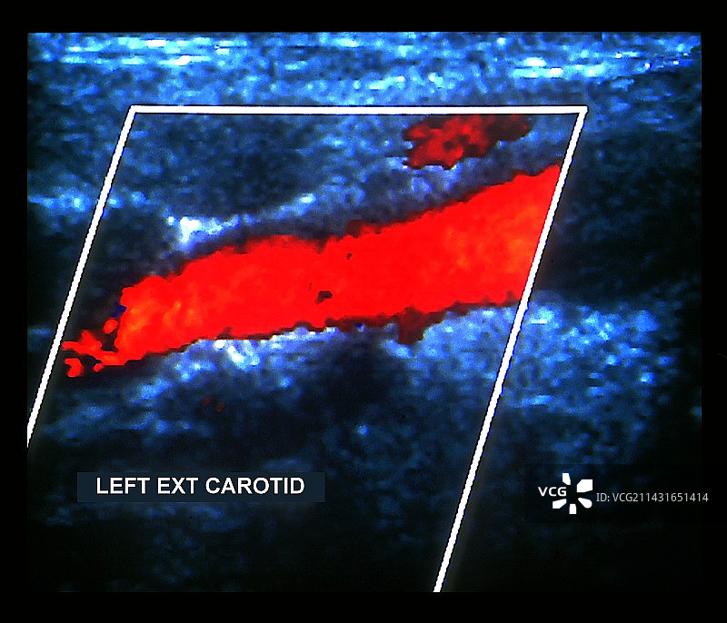 颈动脉多普勒超声扫描图片素材
